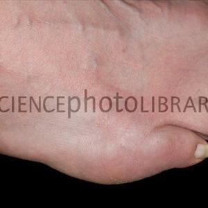 Gout Natural - Hindering Gout