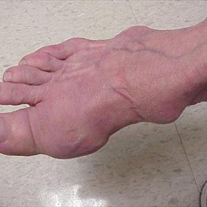 Is Cabbage Rich In Uric Acid - The Argument About Treatment For Gout