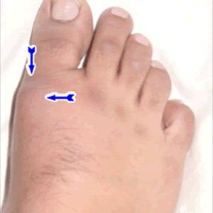  Gout Toe Treatment 