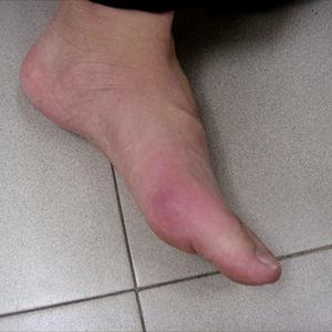  Gout Treatment 