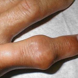 Gout Exer - Remedies For Gout You Ought To Know
