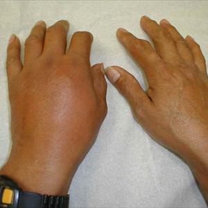 Treatment Of Gout - What Can Those With Gout Carry Out To Stay Healthy?