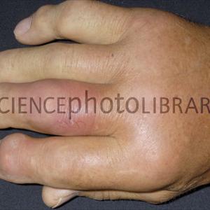  Gout Treatment 