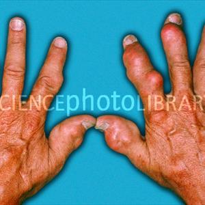 Uric Acid Build Up In Joints - Effective Methods Of Getting Rest From Gout Pain