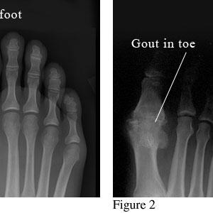  Cure Gout Within 2 Hours Or Less