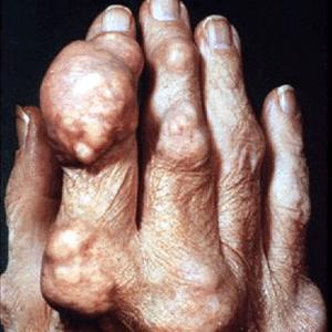 Colchicine Replacement For Gout - Food Products To Be Just Avoided By Gout Patients