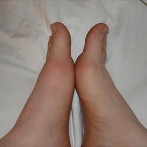 Goutazal - Searching With Regard To Typical Gout Cures
