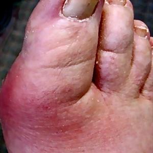 Free Natural Gout Remedy - Soothe Gout Arthritis With Medicines And Natural Remedies