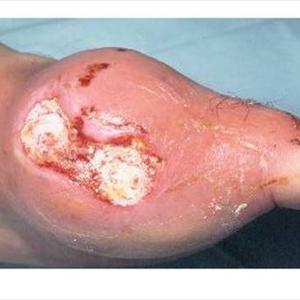  Gout Is Painful And Treatment Is Essential