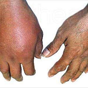 Foods That Cause Uric Acid - Homeopathic Way For Gout Treatment