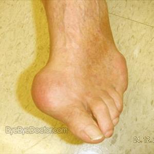 Is High Uric Acid Hereditary - Cure For Gout In Which Will Work - Follow These Tips