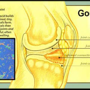 Oatmeal To Help With Gout - Simple And Powerful Home Gout Remedy