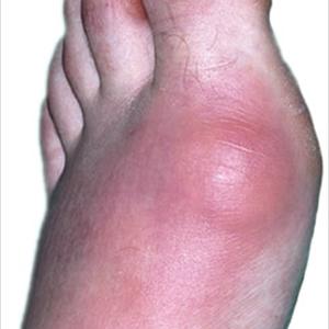 Gout Natural Remedies - Cure Gout Symptoms With Home Remedy Regarding Gout