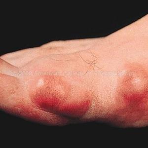 Uric Acid In Eggplant - A Gout Treatment Can Also Suggest A Treatment For Arthritis