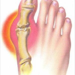 Gout In Vietnamese - In The Next Paragraphs We Will Be Taking A Better Look At The Gout Natural Remedy Repor